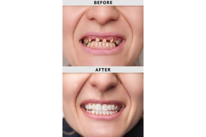 before and after of teeth